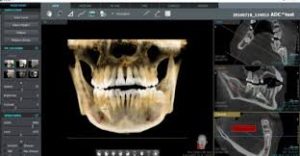 Tomografías 3D, con minima exposicion y radiación minima al emplear equipo nuevo.
